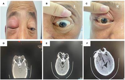 Rhino-orbital-cerebral mucormycosis caused by Rhizopus arrhizus diagnosis via metagenomics next-generation sequencing: a case report